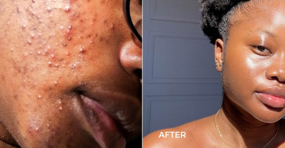 Acne & Scar Treatment