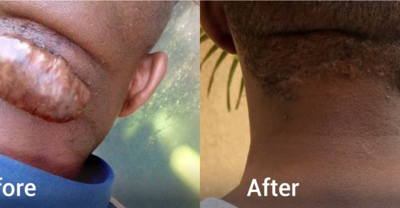 Keloid & Hypertrophic Scars